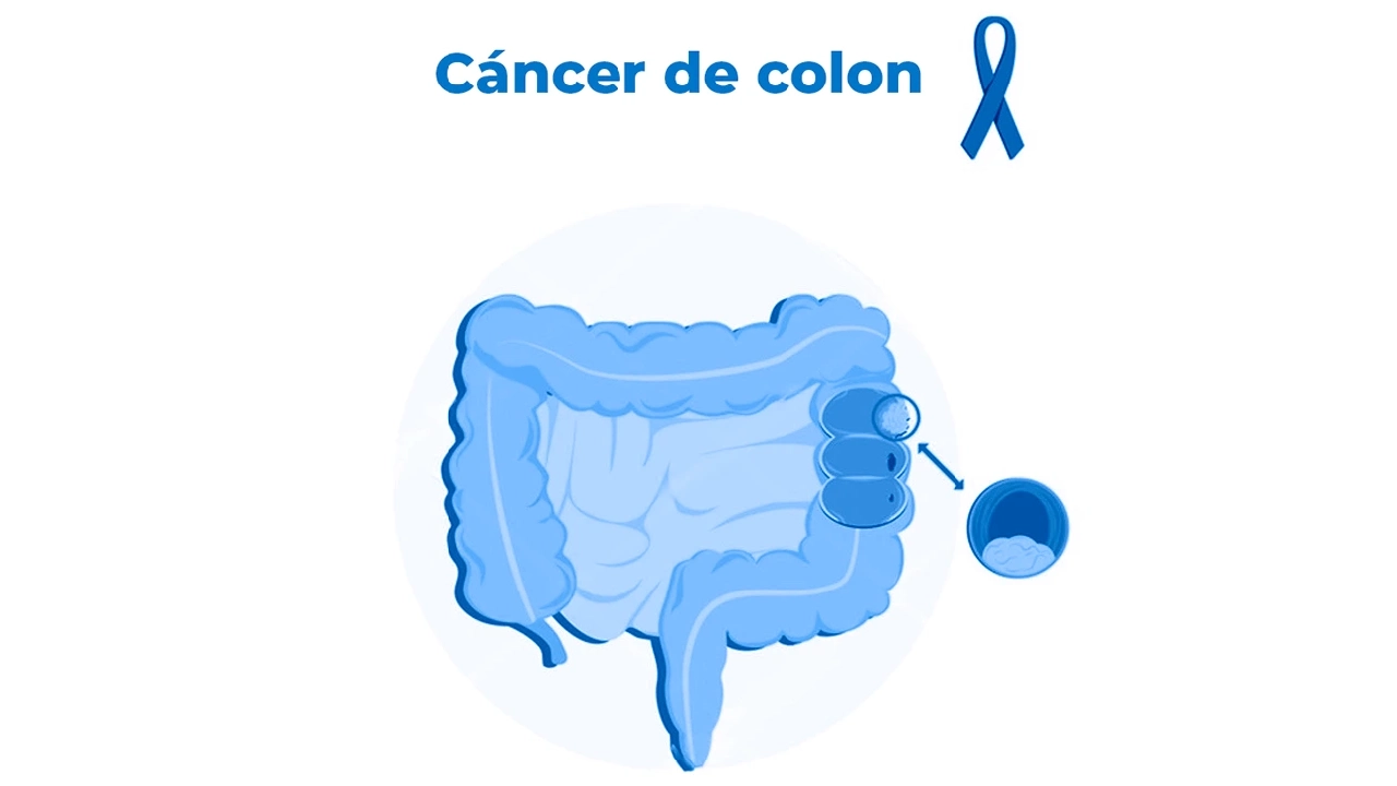How to Prevent Colon Cancer: A Complete Guide